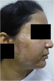 cutaneous lupus erythematosus a review