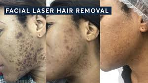 ingrown hairs with laser hair removal