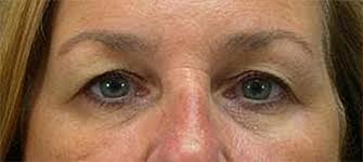 Image result for how to get medicare to pay for saggy eyelids