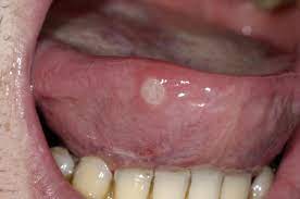 mouth ulcers nhs