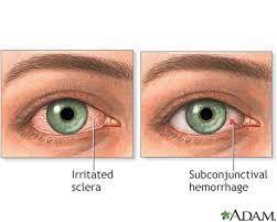 eye redness information mount sinai