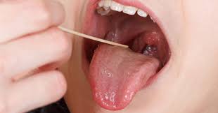 It can start like a small irregular ulcer with whitish/ redish color. Cancer Health Basics Oral Cancer Cancer Health