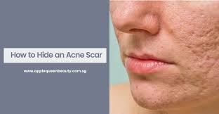 hide acne scars