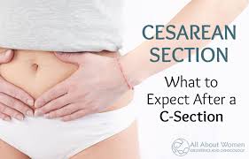 cesarean section what to expect after