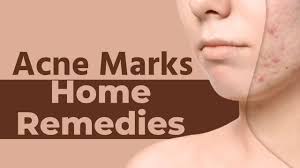 home remes to treat acne scars