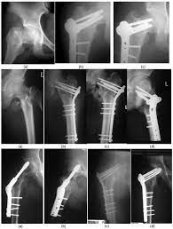 treatment of fem neck fracture with