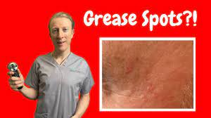 how to get rid of sebaceous hyperplasia