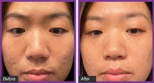 myfacesurgeon com wp content uploads 2023 02 acne