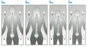 Posture Chart Hudson Valley Scoliosis