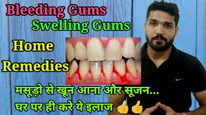 home remes for bleeding gum