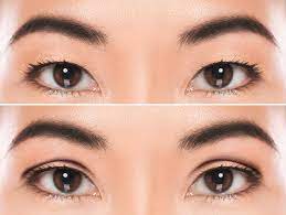 Double Eyelid Surgery - Sydney Cosmetic & Plastic Surgery Clinic