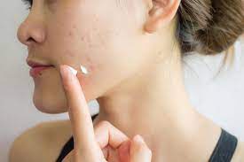 acne scars treat using home remes