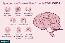 A cerebral stroke required quick medical attention so as to prevent any mishappening or loss of life. Stroke And The Pons Region Of The Brain