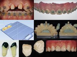 Optical Impression In Restorative Dentistry Intechopen