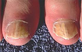 how to treat toenail infection with