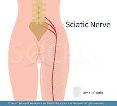 sciatic endometriosis and leg pain