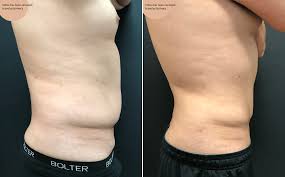 male abs liposuction