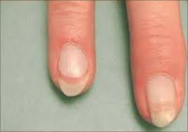 nail dyschromias indian journal of