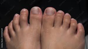 brittle toenails in children cause the