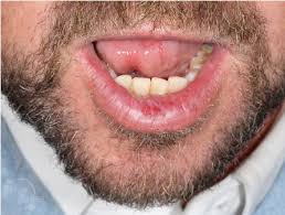 dysplasia of lower lip skin cancer