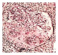 Glomerular Basement Membrane Disease