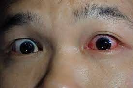 bloodshot eyes after drinking side