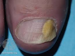 natural remes for fungal nail infections