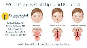 cleft lip and cleft palate dell