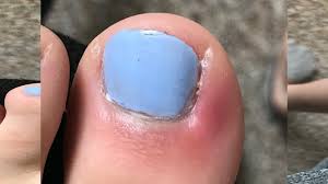 toe infections following pedicures