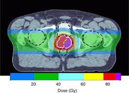 proton beam therapy and localised