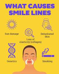 how to get rid of smile lines 5 ways
