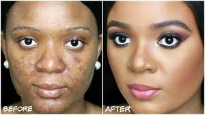 concealing hyperpigmentation with