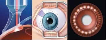 Mr Raj Glaucoma laser, Mr Raj, Mr Raj Glaucoma, Mr Raj Cataract, Glaucoma  monitoring Birmingham, Dudley glaucoma