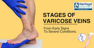 ses of varicose veins early signs