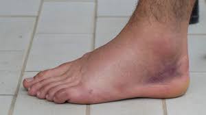 a sprained ankle stay swollen