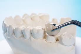 How long does placement of arestin take? How Long Do Dental Crowns Last Precision Dental