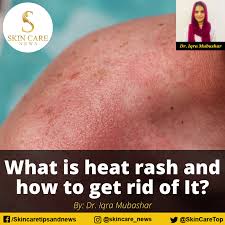 what is heat rash and how to get rid of it