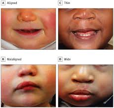 surgical repair of cleft lip
