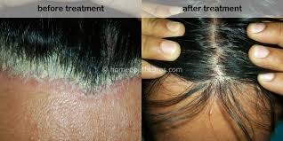 homeopathic treatment for hair fall