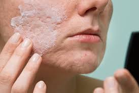 acne scars