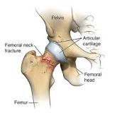 Image result for icd 10 code for closed fracture of right femur