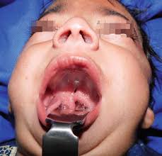 submucous cleft palate for langenbeck