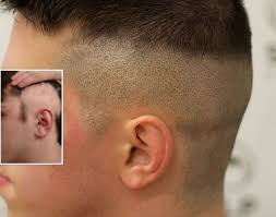 Learn about its symptoms, causes, and treatment. Scalp Micropigmentation For Alopecia Scalp Micro Usa