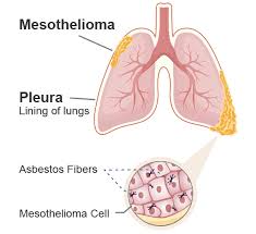 Asbestos fibers have been used in a wide range of household, commercial, & industrial products it is the main cause of mesothelioma cancer. Pleural Mesothelioma Symptoms Causes Treatment