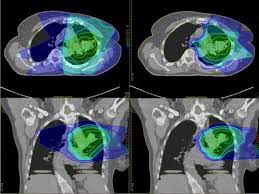 is proton therapy safer than