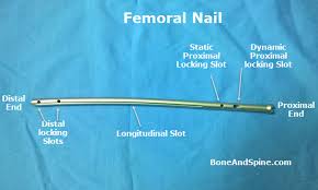 intramedullary nailing of fractures
