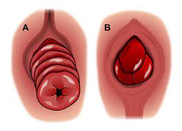 Rectal Prolapse Expanded Version | ASCRS