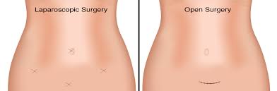 minimally invasive or open surgery