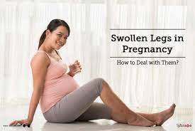 swollen legs in pregnancy how to deal