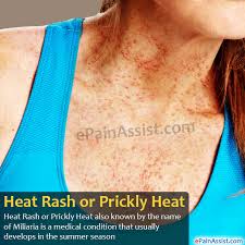 heat rash or ly heat treatment